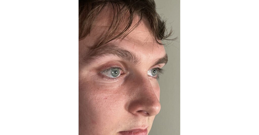 Breakthrough: Patients and Ocularists Impressed by Quality of Computer-Generated 3D-Printed Eye Prostheses